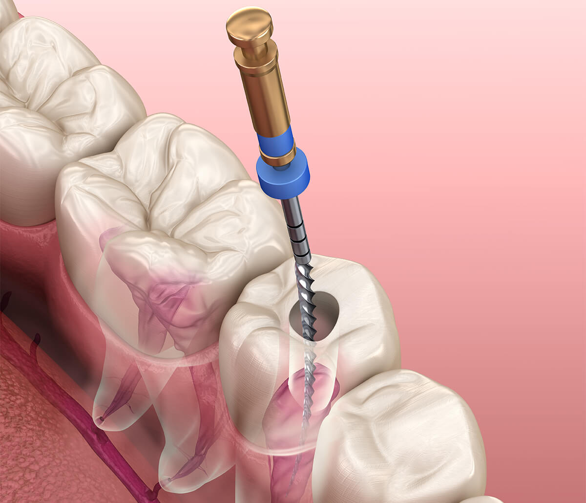 Pain After Root Canal Treatment in Pembroke Pines FL Area